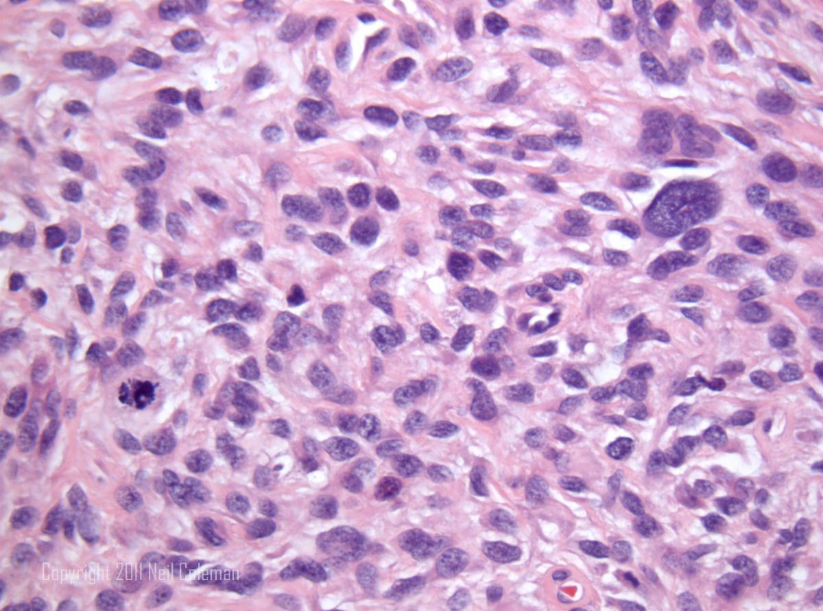 Squamous cell carcinoma - Wikipedia