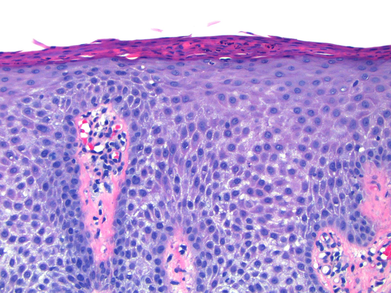 large cell acanthoma #11